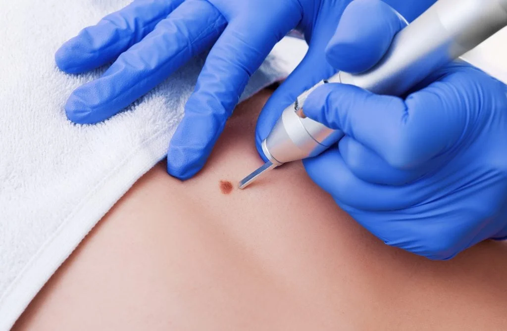 Dermatoscope examination