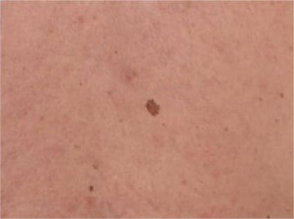 Early Melanoma