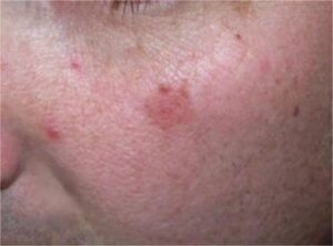 Actinic Keratosis