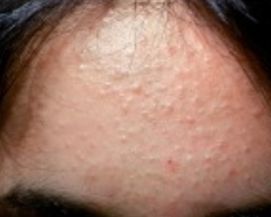 Early Melanoma