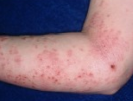 Actinic Keratosis