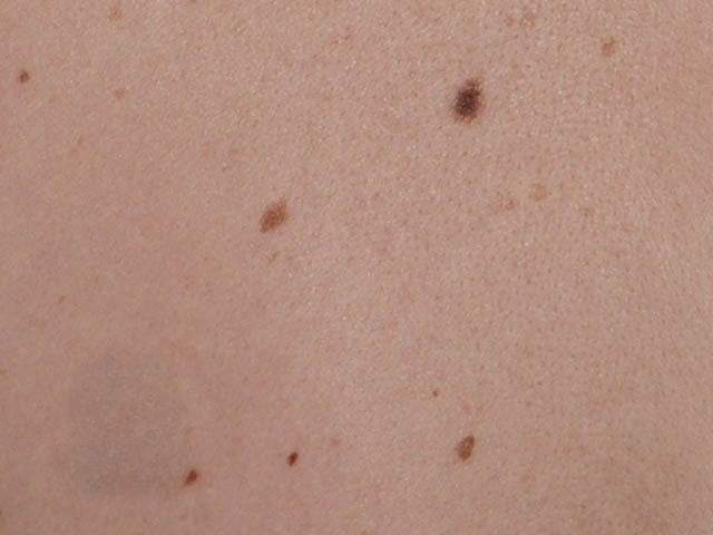 Normal Mole