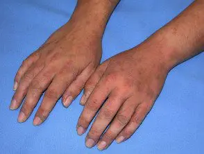 Normal Mole